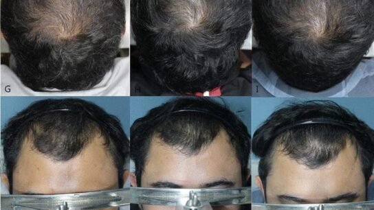 12.5% Minoxidil Topical Solution: High-Strength Option for Hair Regrowth