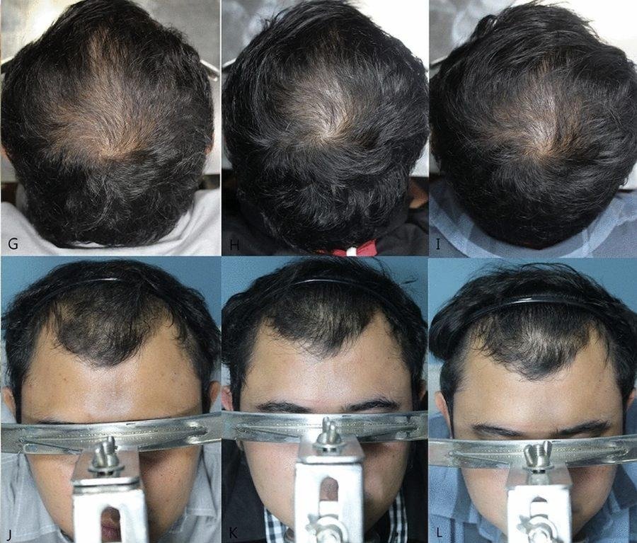 12.5% Minoxidil Topical Solution: High-Strength Option for Hair Regrowth